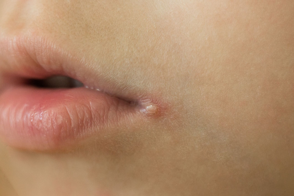 Angular cheilitis